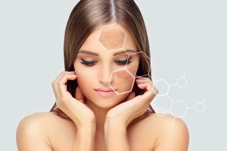 Dark spots, freckles,hyperpigmentation(melasma or chloasma),concept - skin lightening, skin whitening, fruit acids,AHA, Skin Brightening